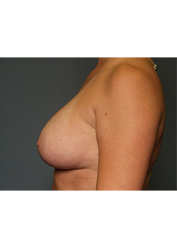 After Image: Breast Augmentation - other